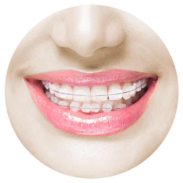 Svg Library Download Invisalign For Adults Teens More - Type Of Clear Brackets Clipart (600x600), Png Download