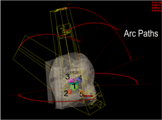 5-arc Rapidarc Radiosurgery Plan Treating 5 Targets - Circle Clipart (850x420), Png Download