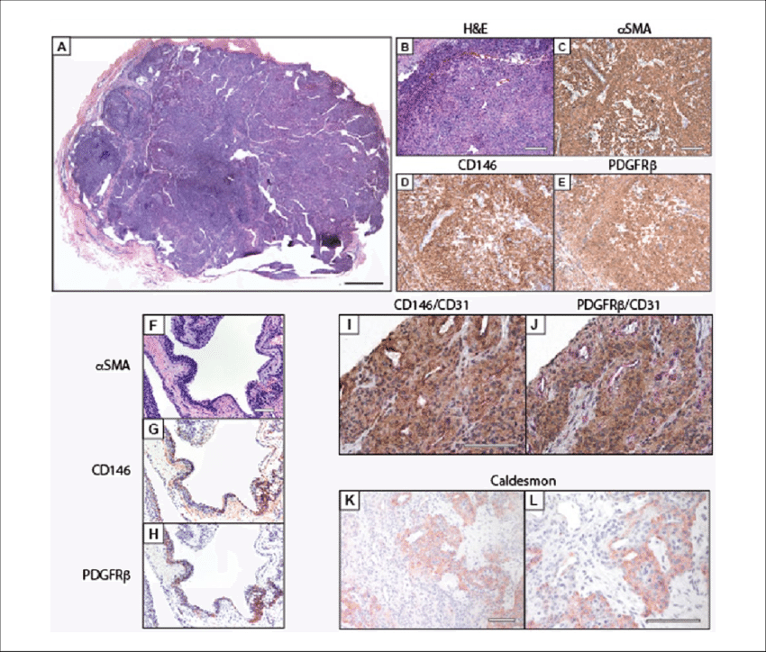 Pericytic Immunophenotype Of Glomus Tumor - Mineral Clipart (850x724), Png Download