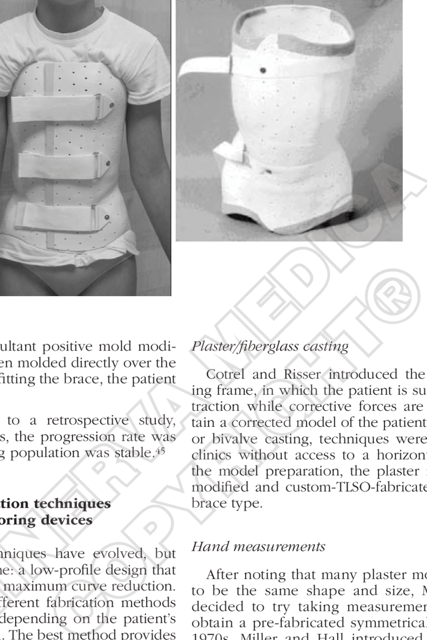 -wilmington Brace - - Wilmington Brace For Scoliosis Clipart (850x1273), Png Download