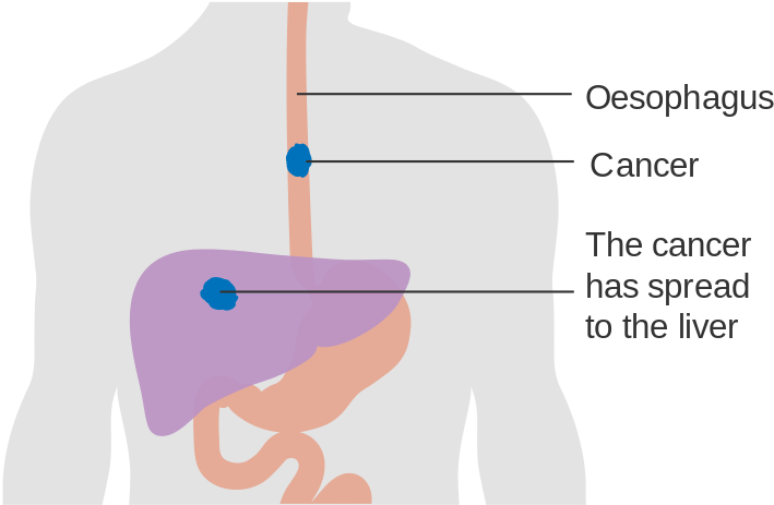 Esophagus Cancer Symptoms - Esophageal Cancer Clipart (800x529), Png Download
