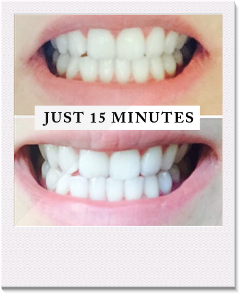 Professional Teeth Whitening System - Pearly White Review Clipart (1000x1000), Png Download