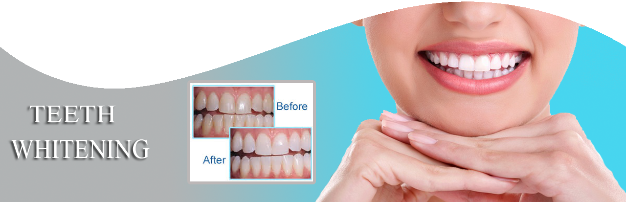 Call Us - Braces Fixed Canted Smile Clipart (1280x413), Png Download