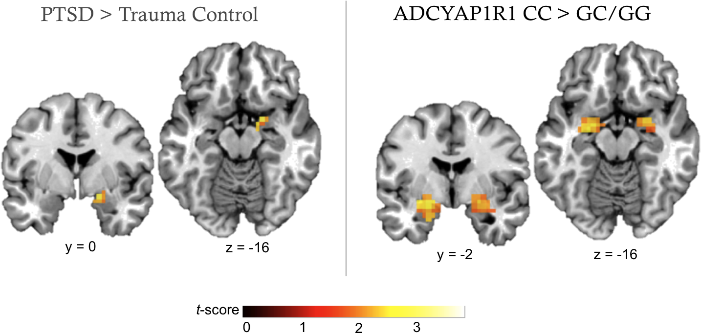 Amygdala Ptsd Mri Clipart (1464x704), Png Download