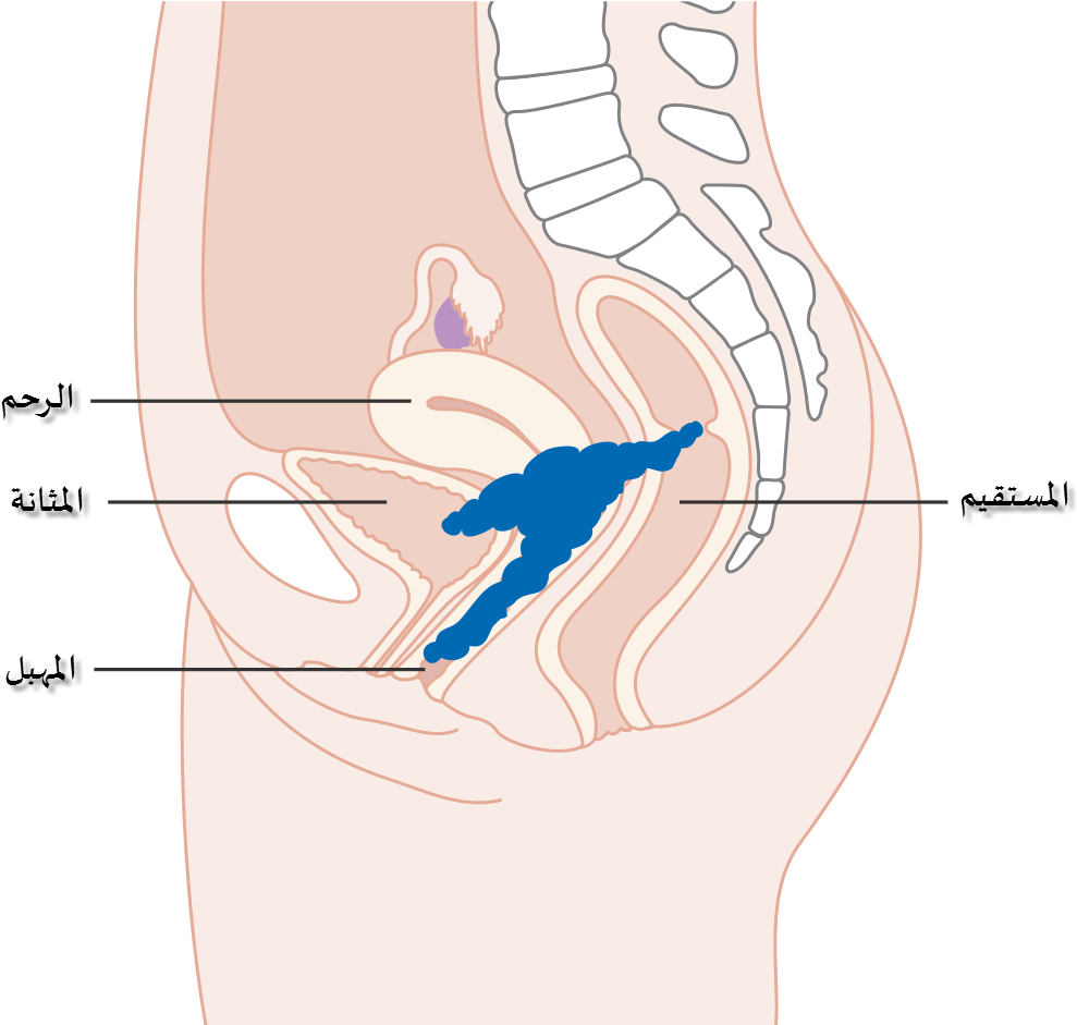 Diagram Showing Stage 4a Cervical Cancer Cruk 236-ar - Illustration Clipart (1200x1024), Png Download