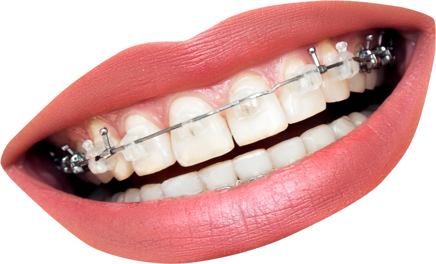 Transparent Mouth With Braces Clipart (1933x1558), Png Download