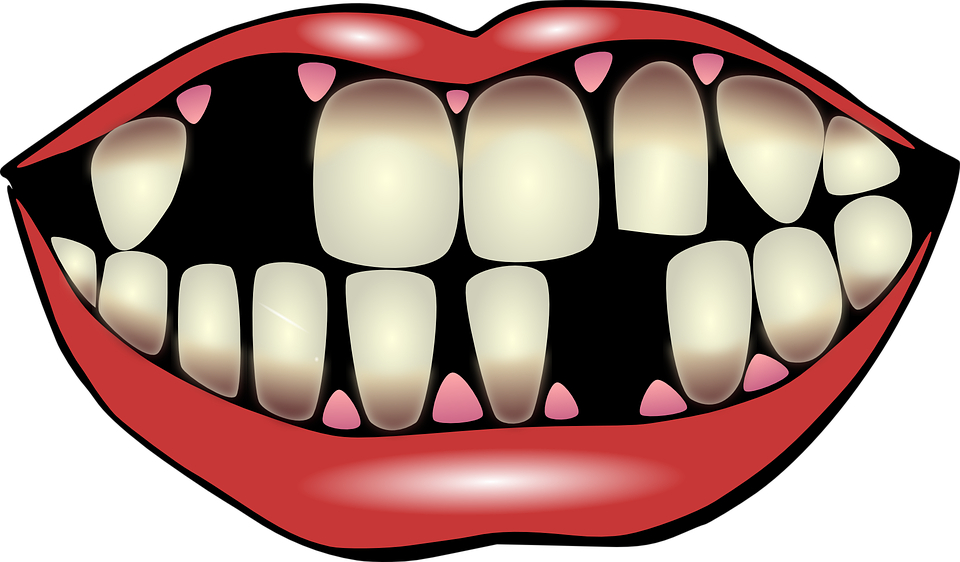 What Leads To Missing Teeth - Missing Teeth Clipart - Png Download (958x560), Png Download