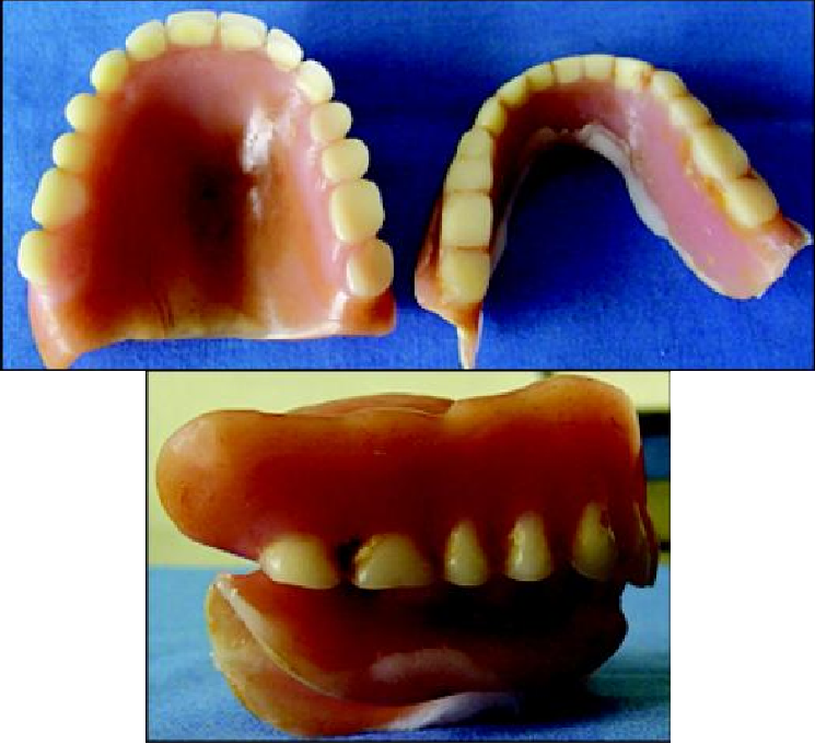 Existing Dentures Of The Patient - Denture Teeth Wear Clipart (745x680), Png Download