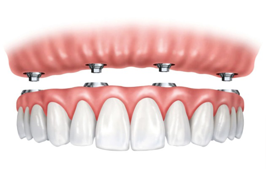 Implant Supported Overdentures - Implant Replacement All Teeth Clipart (1000x1000), Png Download