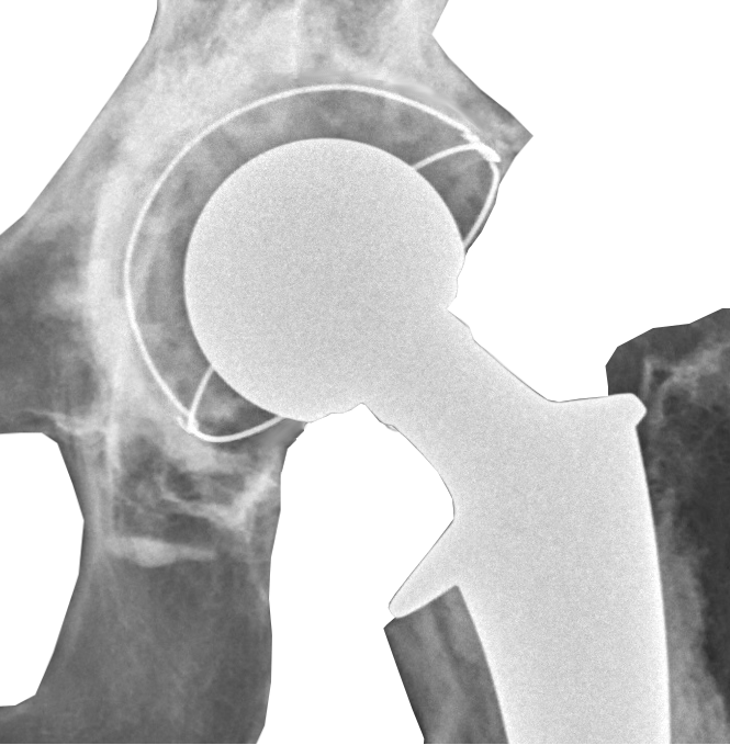 Postoperative Radiograph Of Hip Prosthesis - Hip Replacement Clipart (665x679), Png Download
