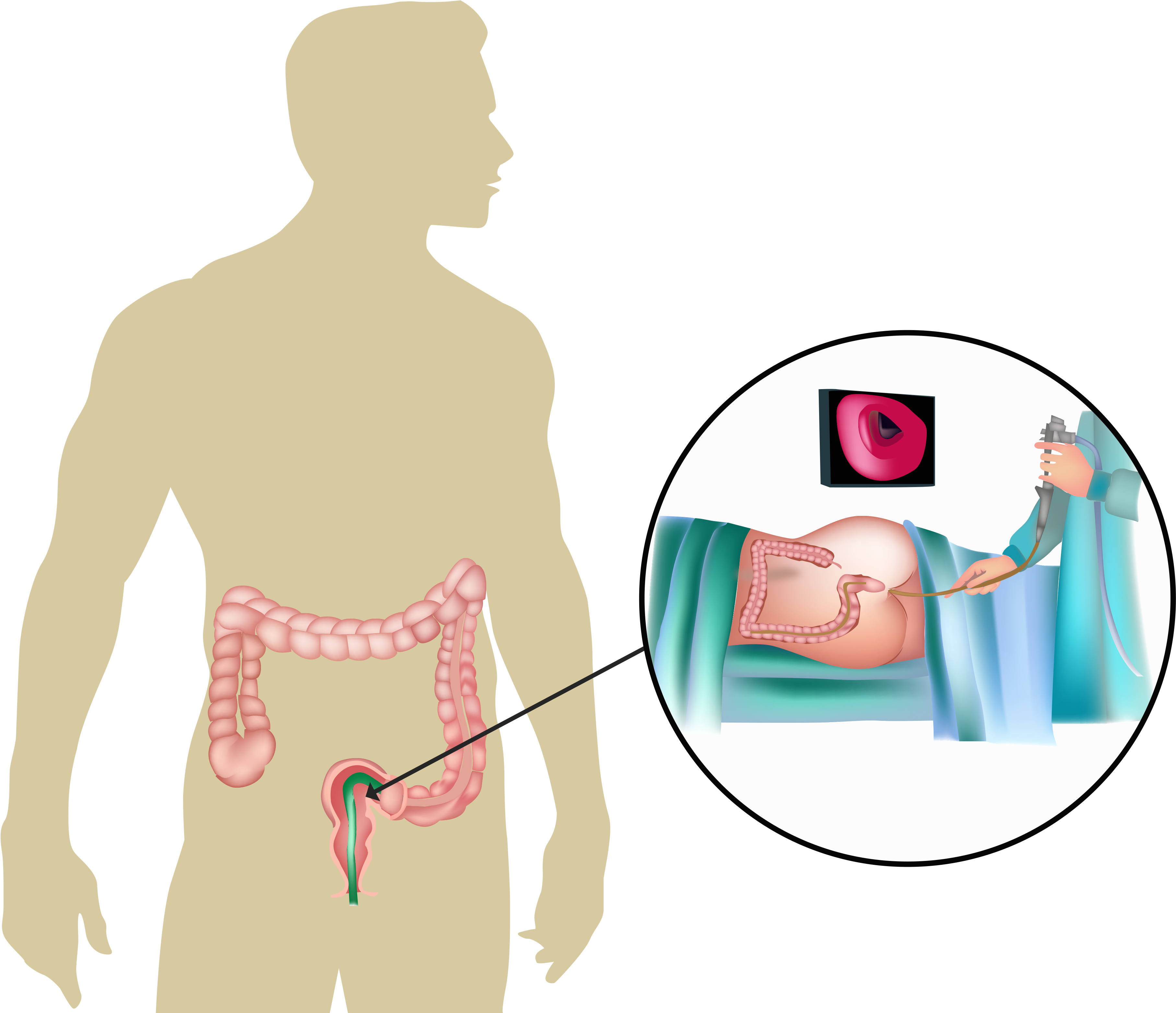 A Flexible Sigmoidoscopy Is A Procedure That Examines - Colon Disease Png Clipart (3628x3124), Png Download