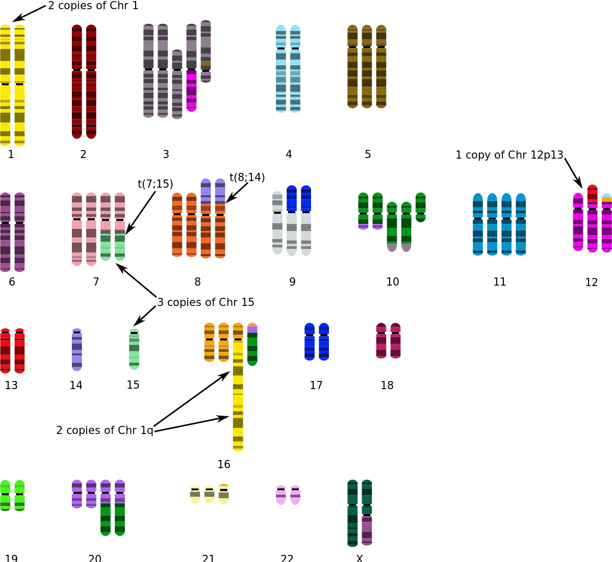 T-47d - Breast Cancer Cell Karyotype Clipart (1200x1102), Png Download