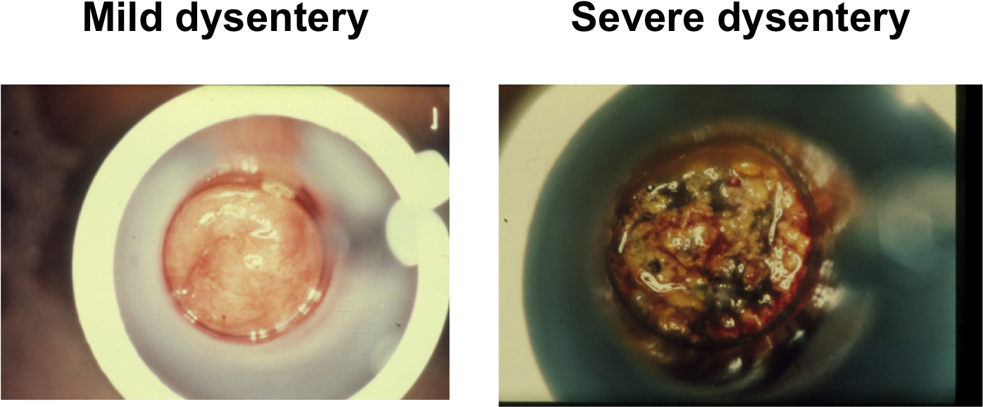 Human Feces, Dysentery, Diarrhea, Jaw, Ear Png Image - Dysentery Feces Clipart (1409x744), Png Download