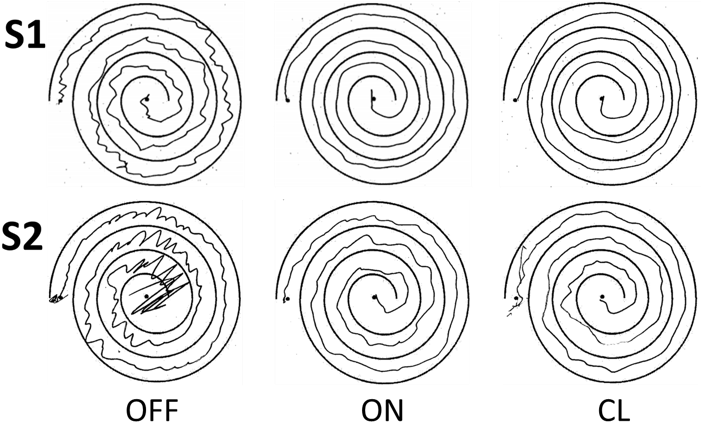 Essential Tremor Vs Parkinson Spiral Clipart (706x458), Png Download