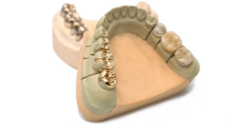 Gold Inlays - Incrustaciones En Oro Dentales Clipart (800x431), Png Download