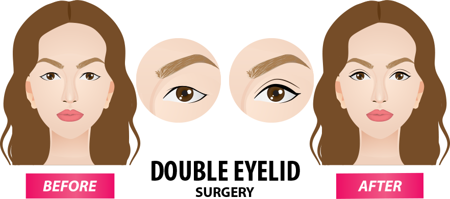 Types Of Double Eyelid Surgery - Girl Clipart (882x391), Png Download