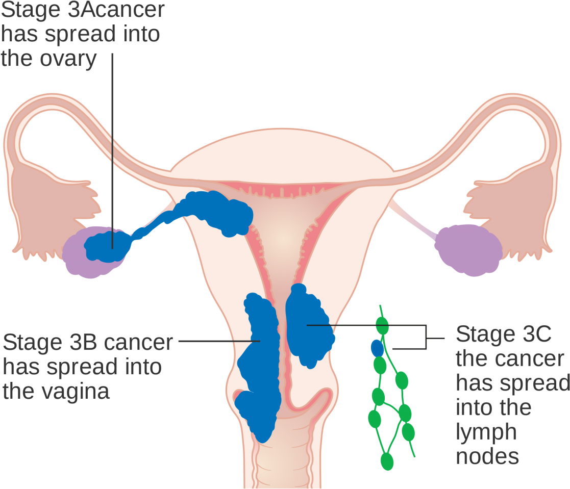 In Stage Iii, The Cancer Has Spread To The Lower Third - 子宮 內 膜 癌 放療 Clipart (1200x1088), Png Download