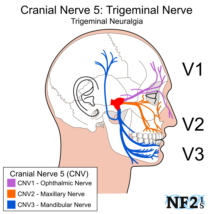 Cranial Nerve 5, Subparts, 3 Branches, Branches, Filiment, - Neurofibromatosis Type Ii Clipart (700x700), Png Download