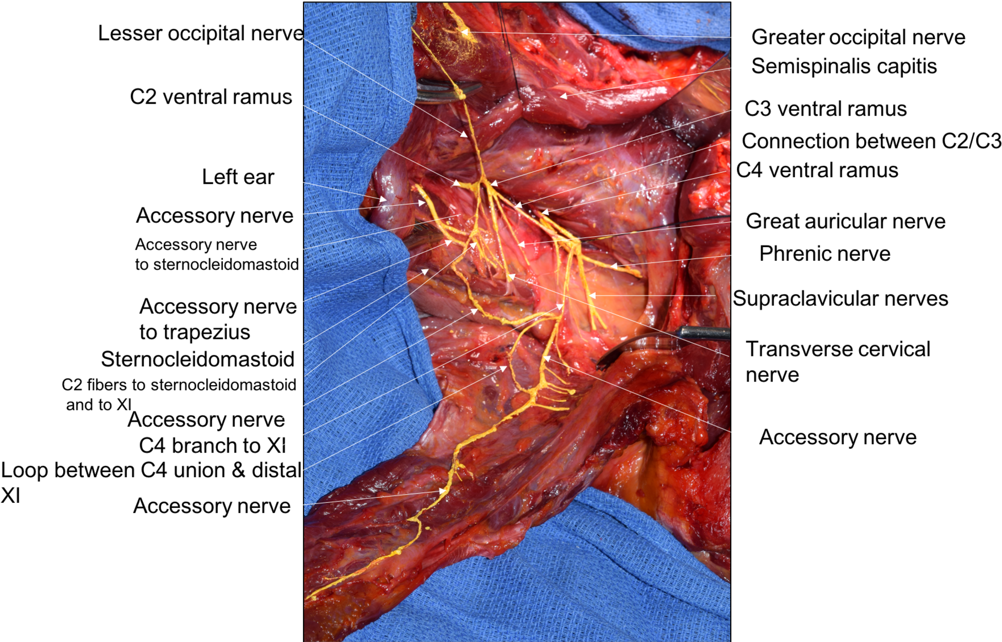 Posterior Dissection Of The Left Lateral Neck - Accessory Nerve Sternocleidomastoid Neck Dissection Clipart (2000x1249), Png Download