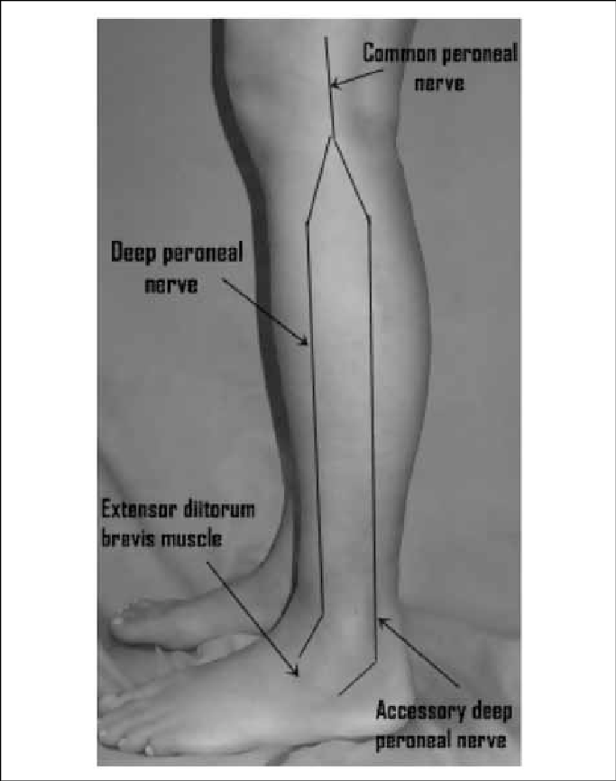 The Accessory Deep Peroneal Nerve - Stimulate Deep Peroneal Nerve Clipart (683x866), Png Download