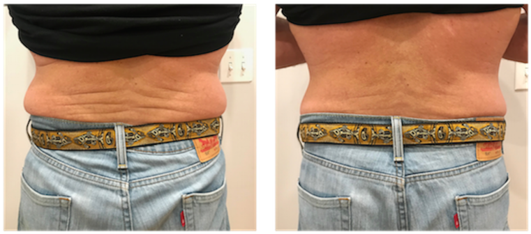 Cryoskin Before After Male 02 - Navel Clipart (800x400), Png Download