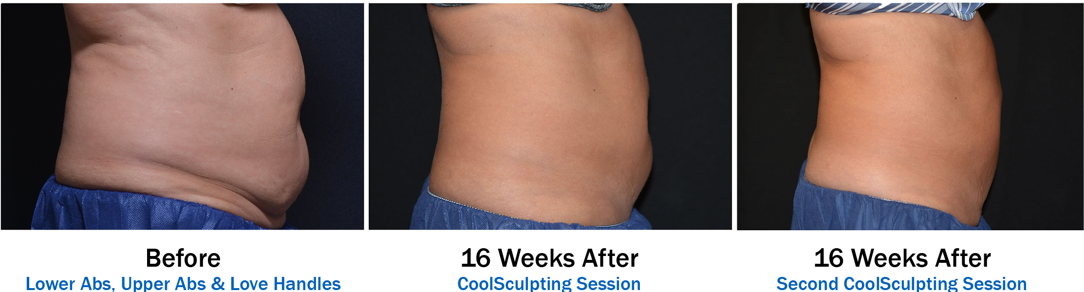 3 Picture Before And Afters For Coolsculpting Orlando-2 - Photo Caption Clipart (2226x600), Png Download