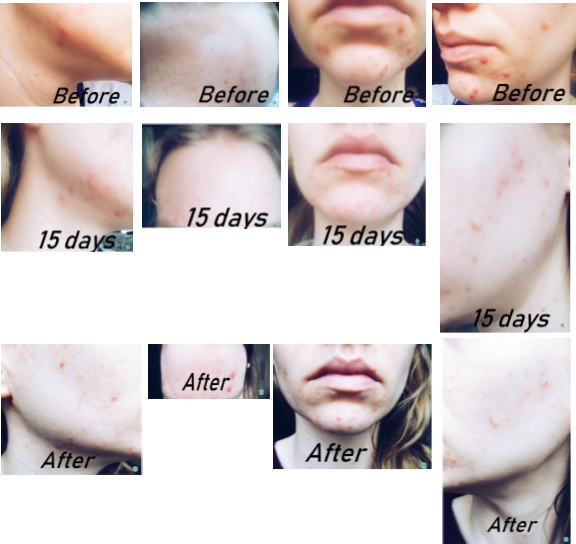 Neutrogena Light Therapy Mask Reviews Clipart (576x544), Png Download