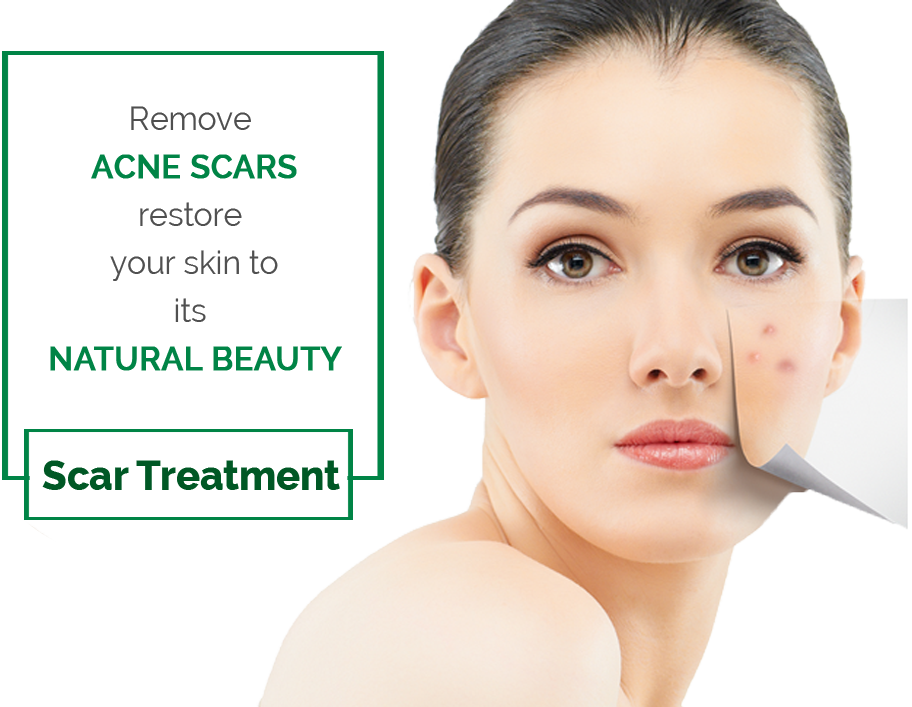 Laser Acne Scars Removal Treatment - Santa Maria Clipart (912x707), Png Download
