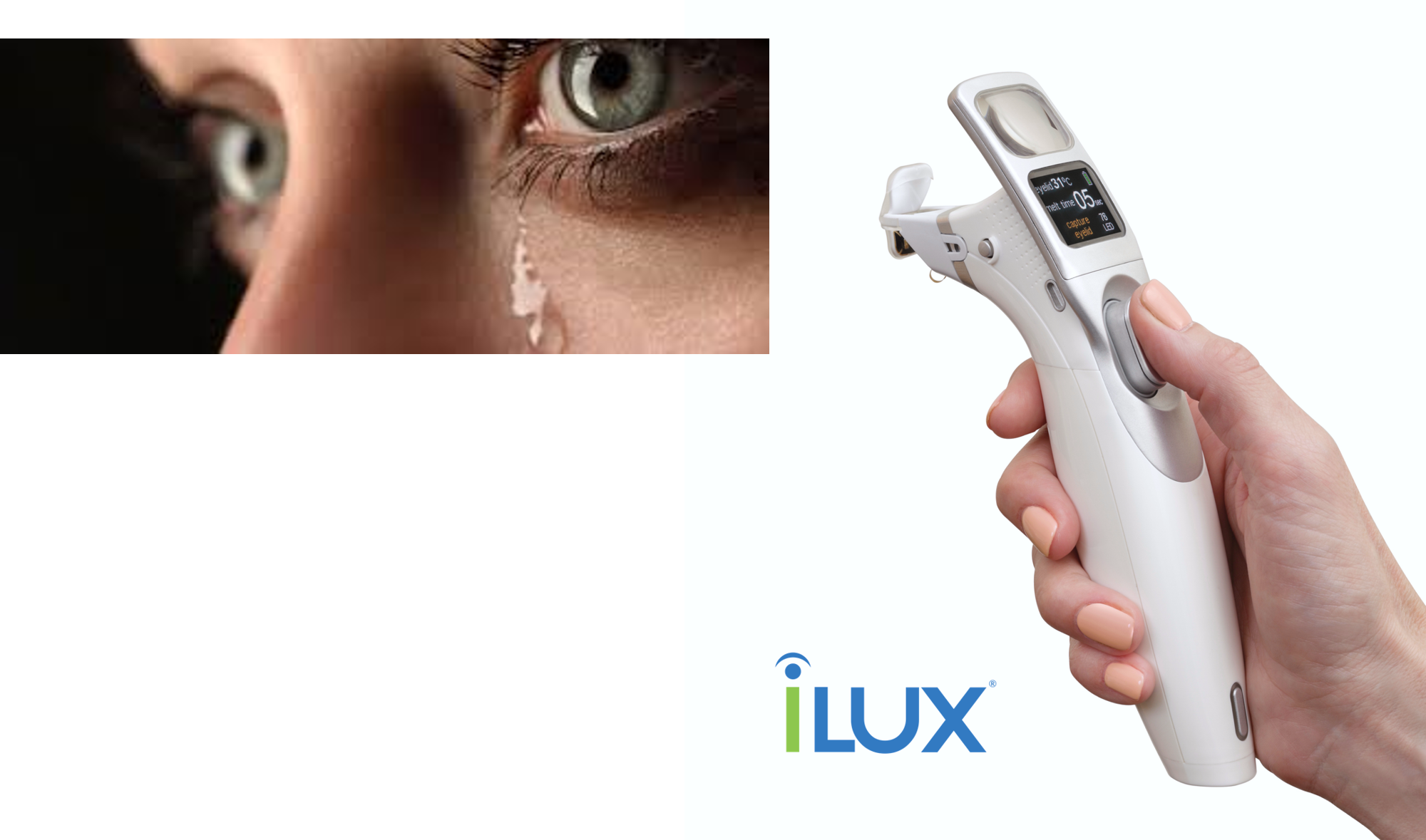 Tearfilm Innovations Ilux® Dry Eye Treatment System - Trigger Clipart (2000x1179), Png Download