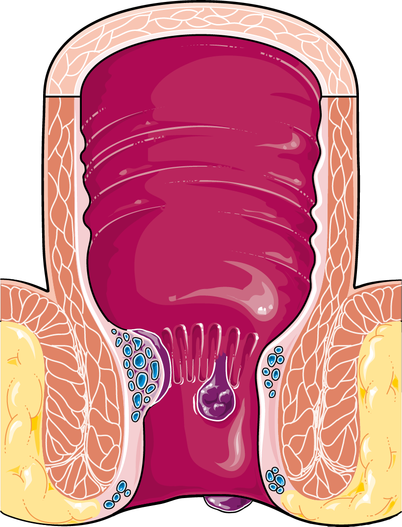 Liver Svg Png Icon Free Download - Hemorrhoids Png Clipart (821x1074), Png Download