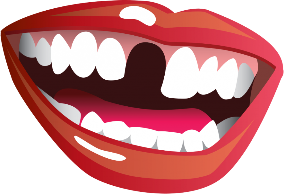Smile With Missing Tooth Clipart (1024x706), Png Download