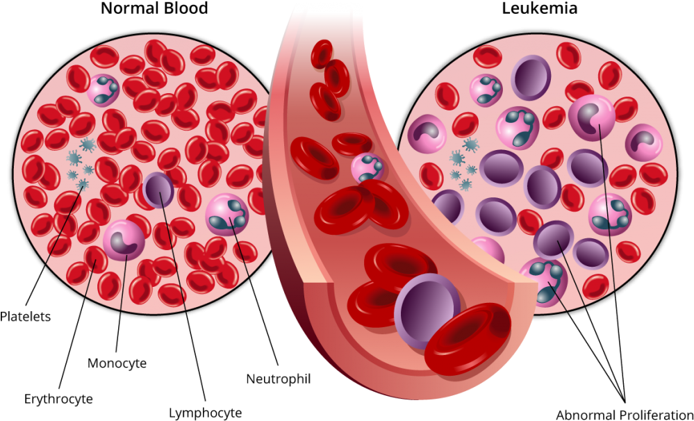 Stages Of Leukemia - Cancer Blood Clipart (1024x660), Png Download