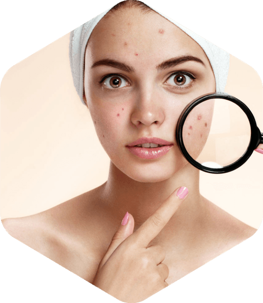 Types Of Acne Scarring - Acne Treatment Png Clipart (523x602), Png Download