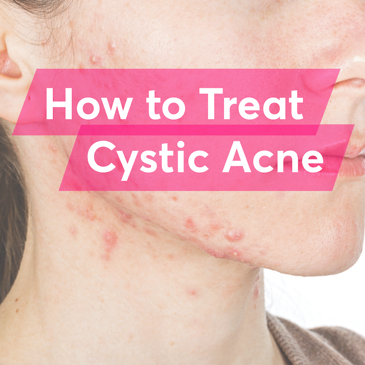 What Is The Best Treatment For Cystic Acne - Tattoo Clipart (750x750), Png Download