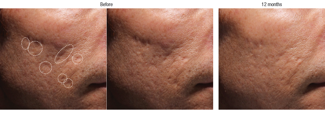 Bellafill Acne Scar Before And After Photos - Filler For Atrophic Scar Clipart (1264x485), Png Download