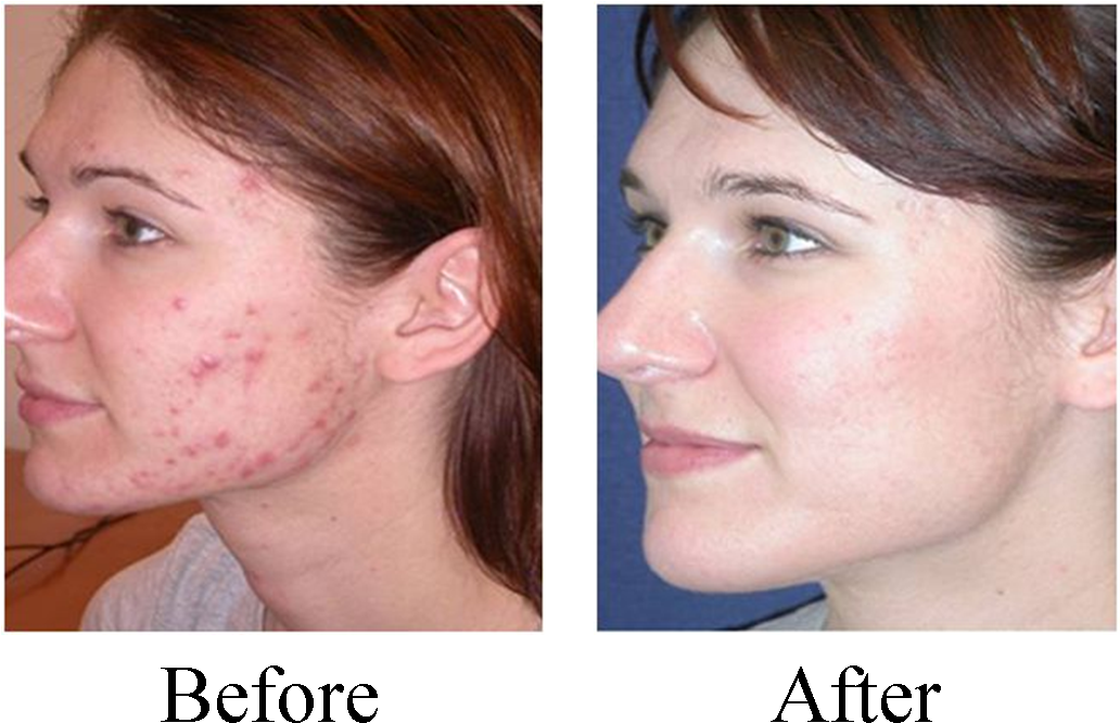 Hopkins Chiropractic Care For Acne & Other Skin Conditions - Dermaplaning Hair Before And After Clipart (1032x722), Png Download
