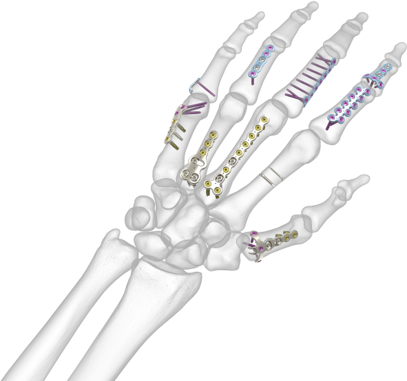 See All Images - Transparent Bone Hand Png Clipart (1024x576), Png Download