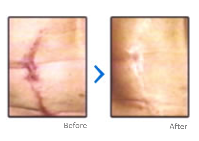 Scar Treatment Results - Plywood Clipart (740x540), Png Download