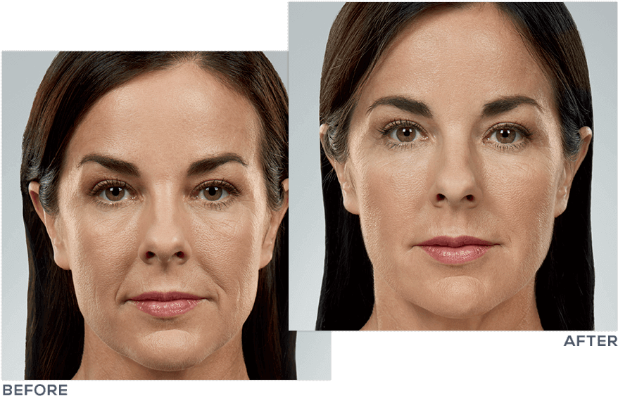 Juvéderm® Facial Filler Treatment - Juvederm Face Clipart (908x592), Png Download
