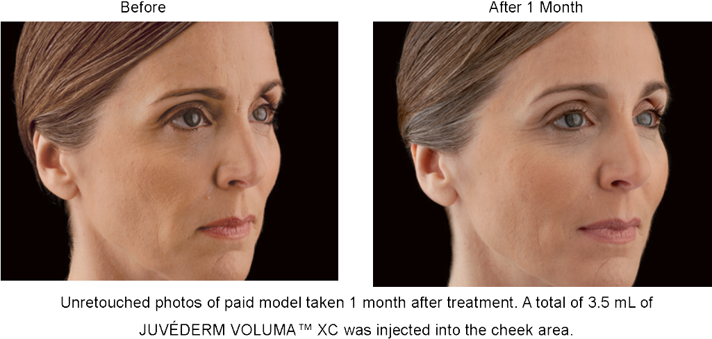 Juvederm Voluma Xc Before And After Picture - Cheek Augmentation With Fillers Before And After Clipart (1024x503), Png Download