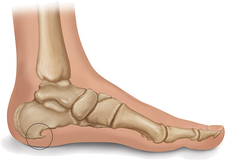 Heel Spur Illustration - Trn U Peti Clipart (789x565), Png Download