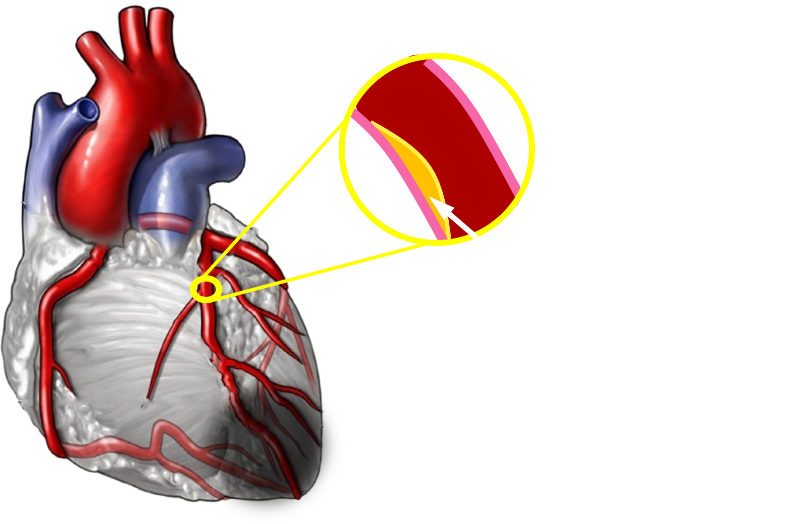 Less Pressure Is Generated By Hearts With Damaged Tissue - Coronary Artery Disease Png Clipart (1655x1116), Png Download