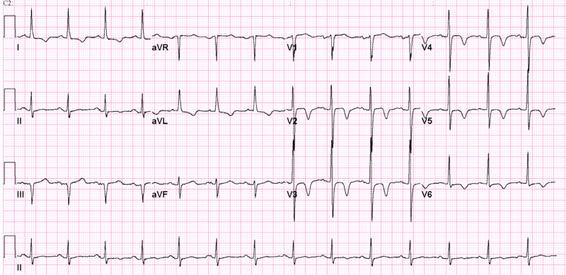 Cerebral T Waves - Neurogenic T Waves Clipart (800x389), Png Download