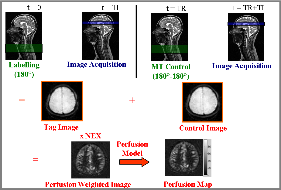 Arterial Spin Labeling-experiment - Normal Neck Mri Clipart (954x625), Png Download