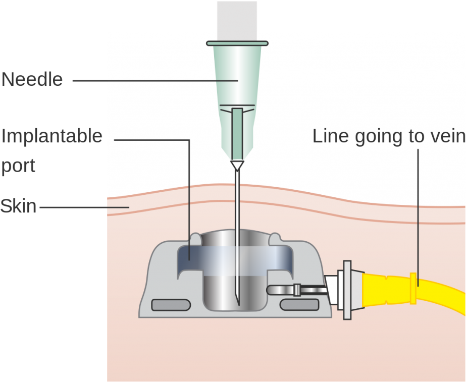 To Help Better Understand And Get A Visual Of What - Port A Cath Clipart (1024x857), Png Download