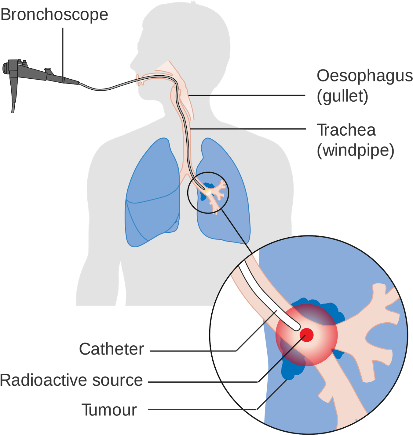 Radiation Therapy For Cancer Clipart (1463x1600), Png Download