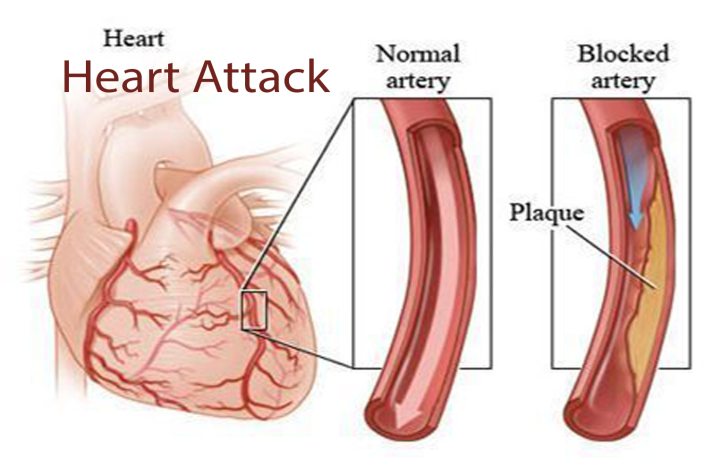 Coronary Angiography Clipart (825x510), Png Download