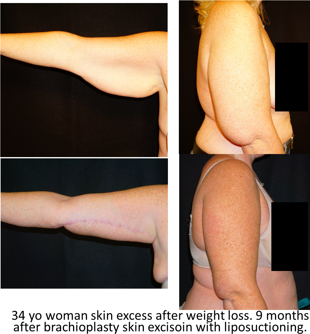 Arm Lift - Photo Caption Clipart (1054x1126), Png Download