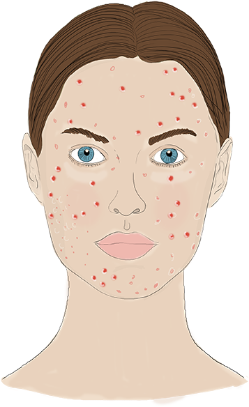 Acne Png - Illustration Clipart (576x600), Png Download