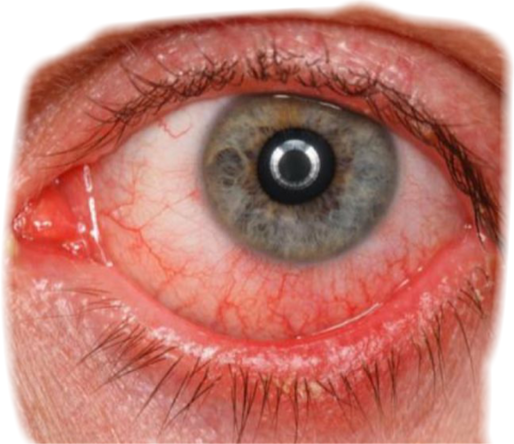 Eye Redeye Bloodshot Bloodshoteye Eyes Red - Симптом Повышенного Глазного Давления Clipart (1024x884), Png Download